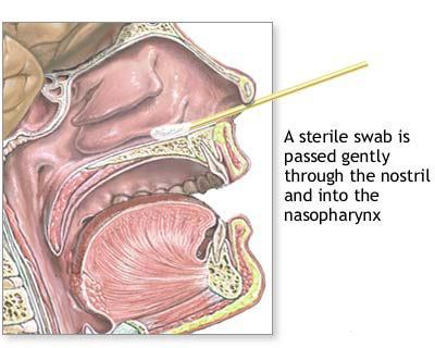 NP Culture A nasopharyngeal culture