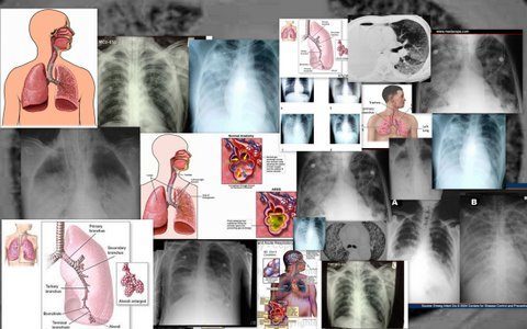 Picasa Acute Respiratory Disease Syndrome (Ards) - A Very Serious Lung Condition