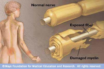 R7_Myelinsheath Myelin Sheath Damage Occurs In Gbs