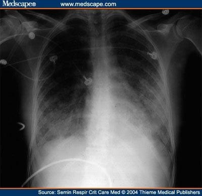 art-src477697.fig2 “Flaards -- sometimes with associated multiple organ failure -- is the most common syndrome and has the highest attributable mortality,” noted doctors in Australia and New Zealand.