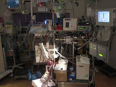 ECMOMachine ECMO Machine in an ICU