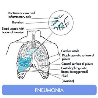 pneumonia Besides flaards, the other predominant disease patterns associated with the pandemic flu virus are community-acquired bacterial pneumonia and an exacerbation by the virus of airflow limitation.