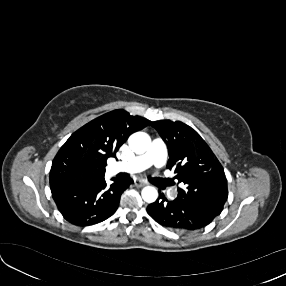 &Quot;The Majority Of Patients Undergoing Chest X-Rays With H1N1 Have Normal Radiographs (X-Rays),&Quot; She Added. Pulmonary Emboli Are Also Not Normally Seen In Flu, She Said. &Quot;Ct Scans Proved Valuable In Identifying Those Patients At Risk Of Developing More Serious Complications As A Possible Result Of The H1N1 Virus, And For Identifying A Greater Extent Of Disease Than Is Appreciated On Chest Radiographs.&Quot;