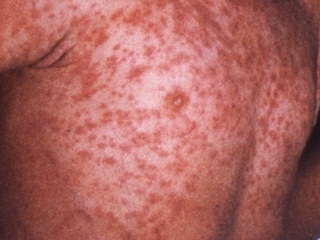 Pictures Of Measles
