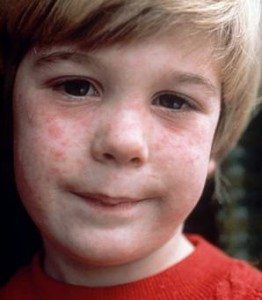 Children Measles 1