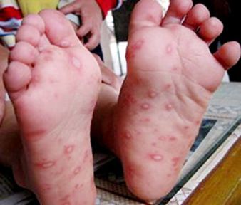 Hand Foot Mouth Disease2