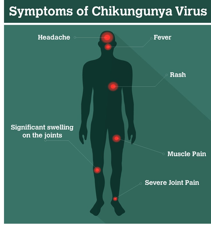 Chikungunya: First Us Locally Acquired Case In Texas